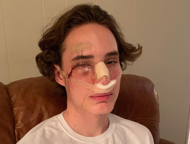Post+surgery%2C+junior+Weston+McGuire+prepares+for+practicing+patience+rather+than+baseball+the+next+few+weeks+as+he+recovers+from+facial+surgery.+Doctors+went+through+his+eye+to+place+a+metal+plate+to+aid+in+the+regrowth+of+his+orbital+bone+that+was+shattered+when+he+was+struck+in+the+face+by+a+baseball.+%E2%80%9CIt+didn%E2%80%99t+hurt+very+much+by+the+time+surgery+came+a+week+later%2C+I+was+just+very+uncomfortable+and+I+just+wanted+to+get+it+over+with.+I+want+to+miss+out+on+as+little+baseball+as+possible%2C%E2%80%9D+McGuire+said.%0A